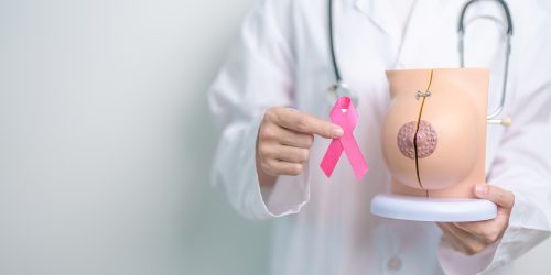 Cáncer de mama
