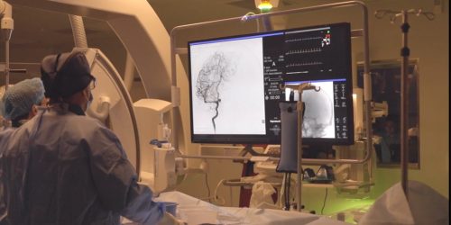 neurocirugía endovascular el pilar